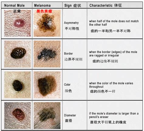 不規則黑痣|非典型痣